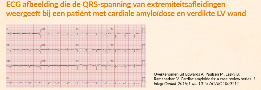 ECG bij cardiale amyloïdose