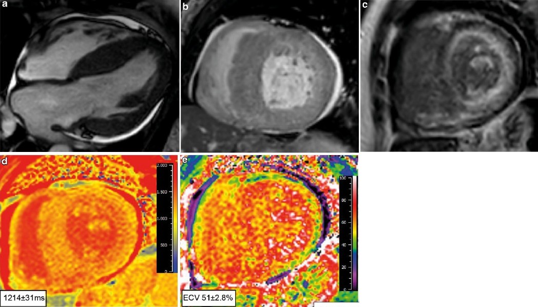 MRI scan bij cardiale amyloïdose